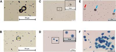 Novel Non-Invasive Diagnosis of Bladder Cancer in Urine Based on Multifunctional Nanoparticles